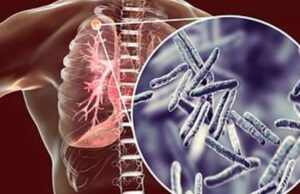 टीबी से मौत रोकने के लिए तमिलनाडु सरकार की नई रणनीति कारगर