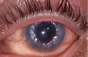 सिम्स में नेत्रदान से मिली रोशनी सिम्स में हुआ कॉर्निया प्रत्यारोपण का सफल ऑपरेशन