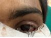 स्किन ग्राफ्टिंग से मरीज के पलक का सफल पुनर्निर्माण,,,,,