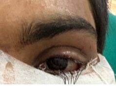 स्किन ग्राफ्टिंग से मरीज के पलक का सफल पुनर्निर्माण,,,,,