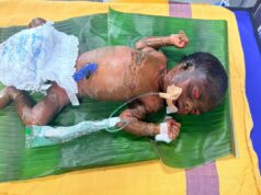 सुदूर बीजापुर में चिकित्सा चमत्कार : अत्यंत दुर्लभ बीमारी से जूझते शिशु को बचाया