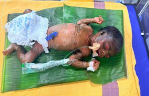 सुदूर बीजापुर में चिकित्सा चमत्कार : अत्यंत दुर्लभ बीमारी से जूझते शिशु को बचाया