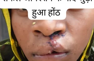 सफल सर्जरी से भीमे हेमला के चेहरे पर लौटी मुस्कान, जन्मजात होंठ की विकृति का हुआ सफल उपचार